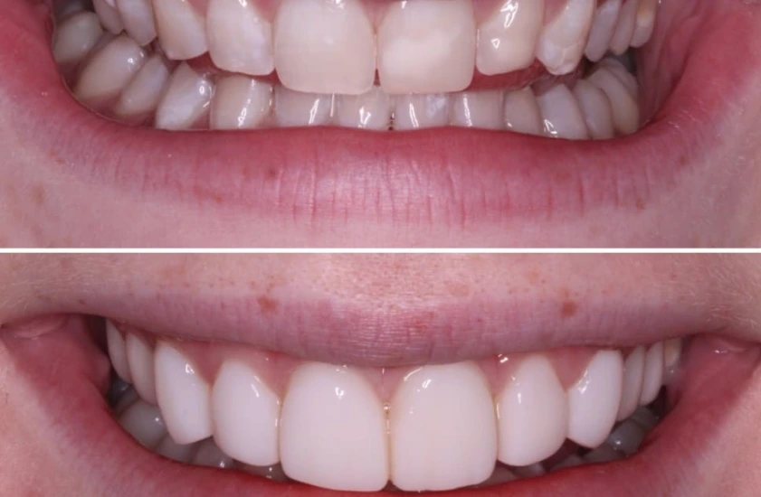 Implants Before-After