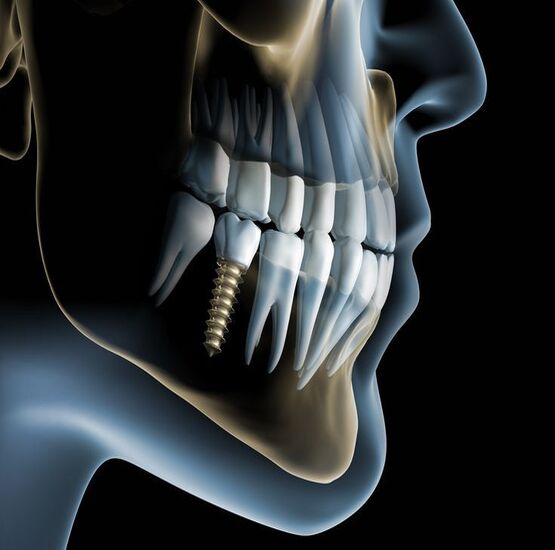 Titanium Dental Implants