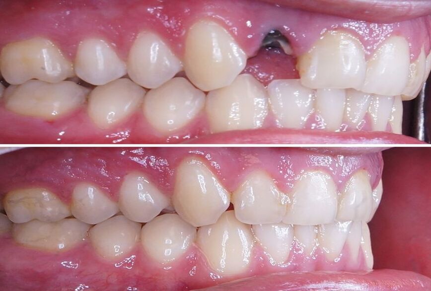 before after