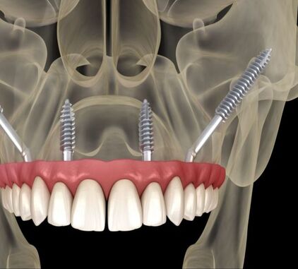 Zygomatic Dental Implant