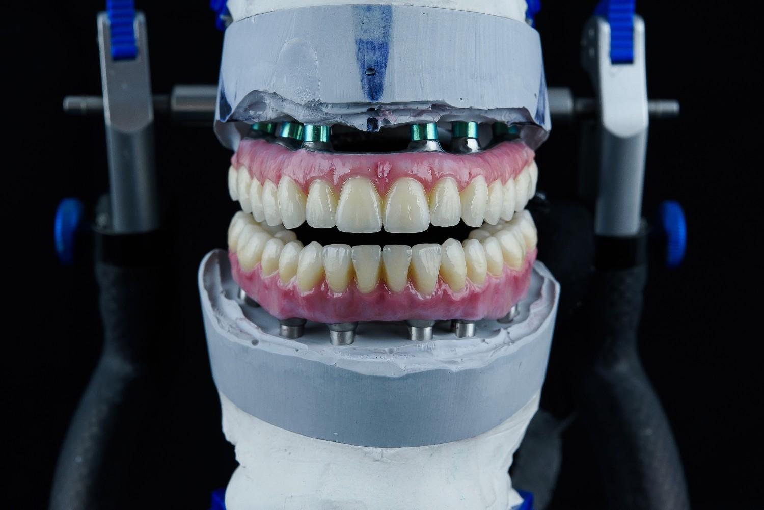Full Mouth Dental Implant